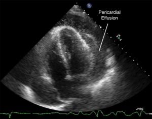 Atypical presentation of STEMI with pericardial effusion causing ...