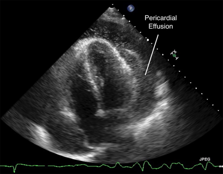 Atypical Presentation Of Stemi With Pericardial Effusion Causing My Xxx Hot Girl