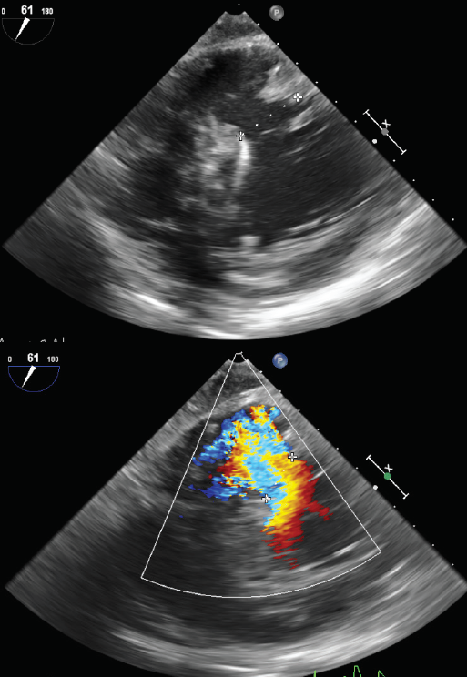 Greco - Figure 1. Intra-operative transoesophageal echocardiogram