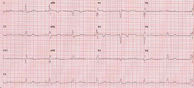 Findley - Figure 1. 12-lead electrocardiogram (ECG) demonstrating complete heart block