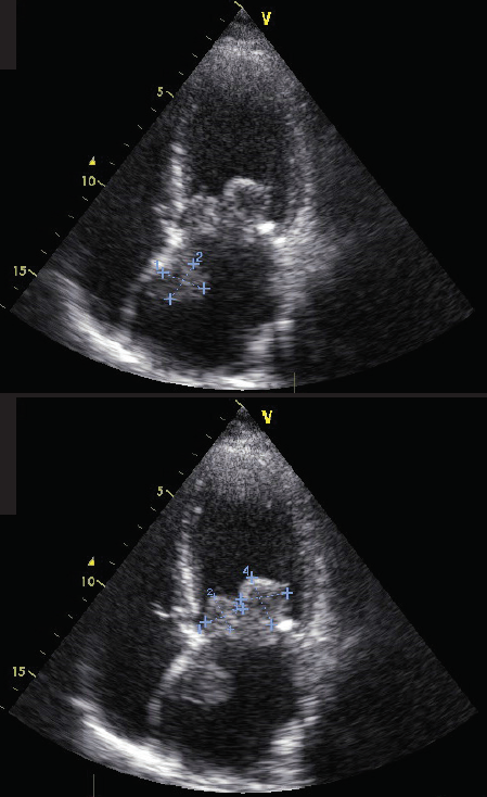 Arakelyanz - Figure 1. Additional mass lesions visualisation: several masses on the cusps of the mitral valve, and one originating from the interatrial septum (apical 4-chamber probe position)