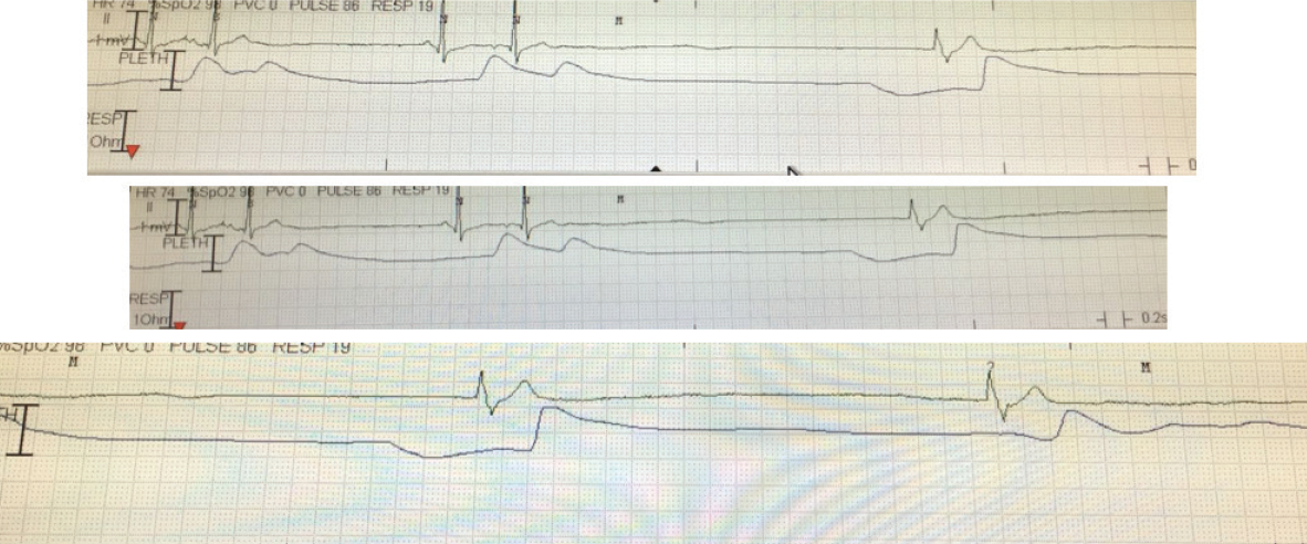 Goss - Figure 1. Cardiac monitor readout