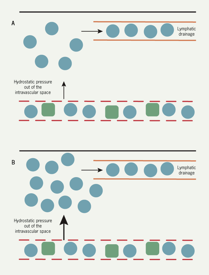 Heart failure module 1 - Figure 12. Diagram showing the physiology of how fluid accumulates in the interstitium of the lung. A illustrates the normal physiology, while B depicts increased venous pressure