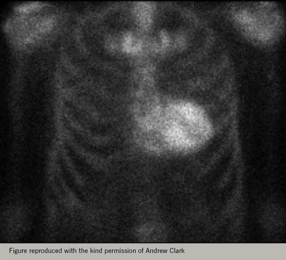 Heart failure Module 2 - Figure 19. Amyloid deposits can be detected by a DPD scan