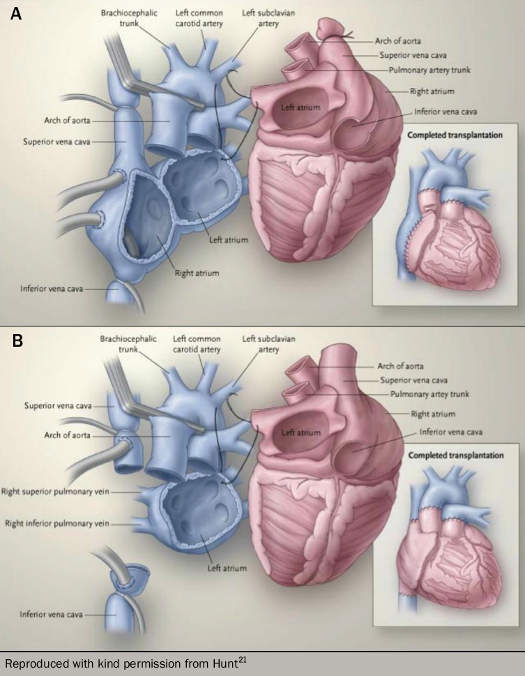 Heart Failure Module 6: Surgical Management - The British Journal Of ...