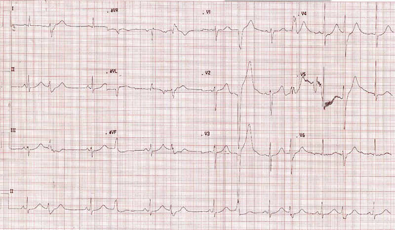 O'Connor - Figure 2. Electrocardiogram showing the drug-induced long QT interval and multiple premature ventricular contractions