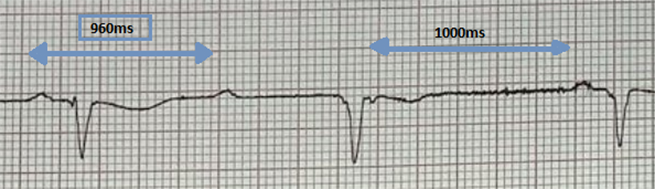 Gondal - Figure 3. Ventriculophasic arrhythmia: the P–P interval with QRS complexes (960ms) are shorter as compared with the P–P intervals without QRS complexes (1000ms)