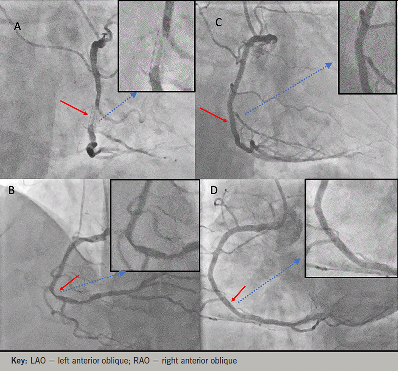 Finnegan - Figure 2. A case of long-standing intra-stent re-stenosis of a bare metal stent in a patient presenting with unstable angina and a sub-totally occluded vessel on a background of 20 years of class 3 angina and previous remote history of failed attempts of re-intervention following identification of the lesion almost 20 years previously, and one year after the initial stenting procedure. A (RAO view) and B (LAO view). In-stent re-stenosis with a sub-totally occluded mid-RCA (red arrows). C (RAO view) and D (LAO view). Restoration of vessel patency (red arrows) following IVL and repeat stenting of the mid-to-distal vessel. Please note that the hashed blue line indicates zoomed thumbnail images