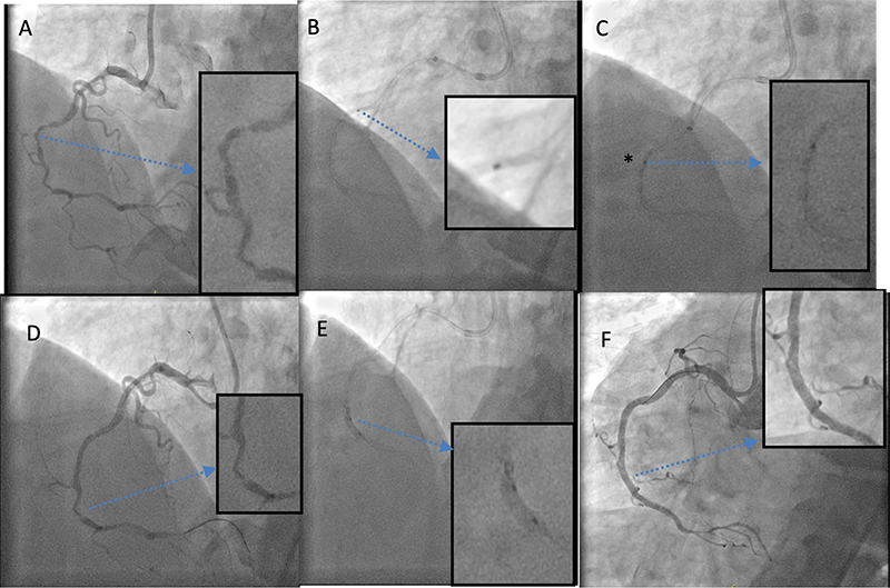 Finnegan - Figure 3. A challenging on-label percutaneous coronary intervention (PCI) of a heavily calcified RCA. A. Dominant right coronary with diffuse calcification sub-totally occlusive disease from mid- to distal-vessel. B. PCI with a 3D right guide extension catheter; note difficulty in advancing balloons. C Under-expansion on 1.5, 2.0, 2.5 mm non-compliant balloons deployed at high pressure (asterisk). D. Severe recoil post-balloon angioplasty. E. Successful intra-coronary lithotripsy with complete balloon expansion. F. Final result after four overlapped drug-eluting stents post-dilated to 3.5 mm. Please note that the hashed blue line indicates zoomed thumbnail images