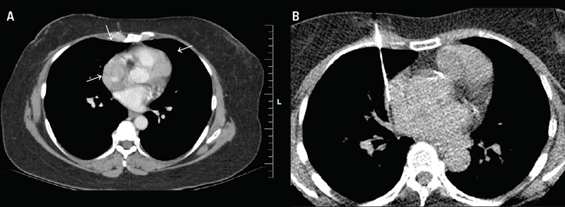 Pourafkari - Figure 1. A. Contrast-enhanced computed tomography (CT) scan demonstrating lobulated cardiac masses encircling lower superior vena cava, right atrial appendage and superior surface of right ventricle (white arrows) extending along the interventricular groove. B. CT-guided percutaneous core needle biopsy of the cardiac mass