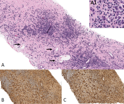 Pourafkari - Figure 2. A. The pericardial tissue biopsy background is composed of stromal fibrosis and shows patchy nodular lymphoplasmacytic infiltrate. The predominant cell component consists of mature polytypic (by kappa and lambda immunostains; not shown) plasma cell clusters (inset A1). Scattered slightly dilated veins are present (arrows) with no obvious evidence of obliterative venulitis by histology. B. and C. Representative images of IgG and IgG4 immunohistochemistry that demonstrate strong co-expression of IgG4 in a major subset of IgG+ plasma cells. There is clear evidence of an increased number of IgG4+ plasma cells (>40 cells; C). No metastatic carcinoma is present