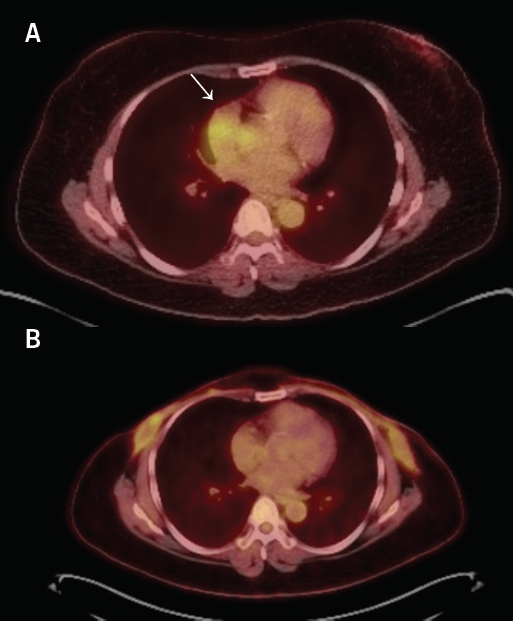 Pourafkari - Figure 3. A. Positron-emission tomography (PET) CT scan demonstrating fluorodeoxyglucose (FDG)-avid cardiac masses (white arrow). B. Follow-up PET CT scan demonstrates a complete metabolic response to treatment. Note of interval bilateral mastectomy and postsurgical changes at surgery beds