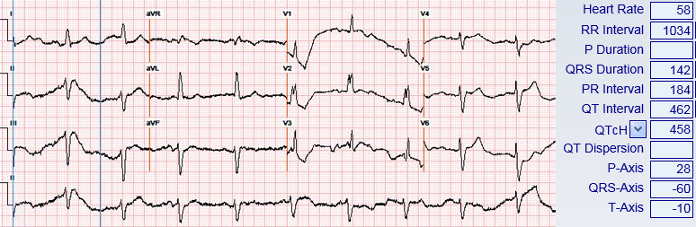 Faulkner - Figure 1. Admission electrocardiogram (ECG) showing sinus bradycardia at 58 bpm, left-axis deviation and partial right bundle branch block (RBBB)