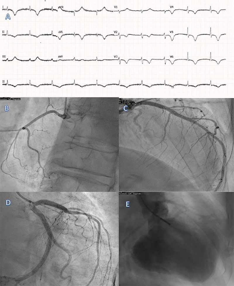 Sekar - Figure 1. A. 12-lead electrocardiogram (ECG) showing atrial fibrillation (AF) with dynamic T-wave inversion in the anterolateral leads and a prolonged QTc interval. B–D. Coronary angiogram showing unobstructed coronary arteries. E. Left ventricular (LV) angiogram demonstrating antero-apical hypokinesis consistent with Takotsubo cardiomyopathy