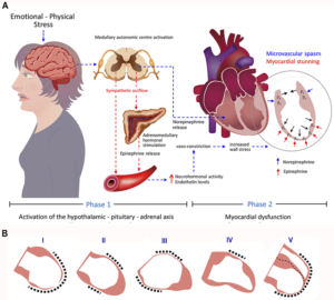 Takotsubo Syndrome: The Broken-heart Syndrome