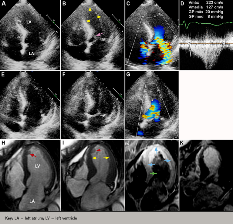 Takotsubo syndrome: the broken-heart syndrome