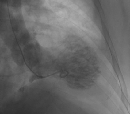 Elamin - Figure 1. Left ventricular angiogram showing the apical ballooning and ‘octopus pot’ appearance