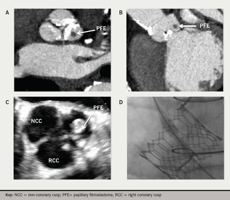 Rahman - Figure 1. Papillary fibroelastoma (PFE): A. Contrast-enhanced computed tomography transverse view. B. Contrast-enhanced computed tomography saggital view. C. Trans-oesophageal echocardiogram mid-epigastric view. D. Fluoroscopic axial view of implanted Sapien valve