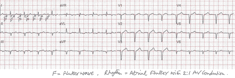 Chatterjee - Figure 3. Explanation added to second ECG showing flutter wave (F) and a 2:1 AV conduction rhythm