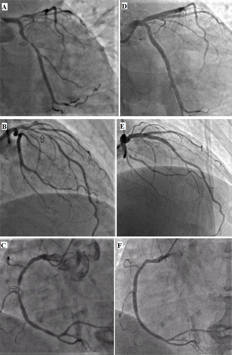 Khanna - Figure 1. Coronary angiogram showing lesions. A. Anteroposterior (AP) caudal view of left circumflex (LCx). B. Right anterior oblique (RAO) cranial view of left-anterior descending (LAD)-diagonal. C. Left anterior oblique (LAO) view of right coronary artery (RCA). D, E and F show corresponding images post-percutaneous coronary intervention (PCI)