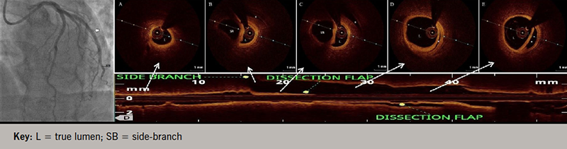 Khanna - Figure 2. Check angiogram in left panel showing suspicion of coronary dissection in left circumflex artery. Right panel shows longitudinal optical coherence tomography (OCT) pullback image (carpet view) and corresponding cross-sectional images at different levels (A–E) showing spiral coronary dissection (marked by asterisk) extending into media sparing the side-branch