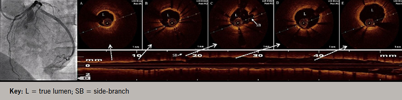 Khanna - Figure 3. Final post-PCI angiogram in left panel showing no evidence of dissection with TIMI (Thrombolysis in Myocardial Infarction) 3 flow. Right panel shows longitudinal OCT pullback image (carpet view) and corresponding cross-sectional images at different levels (A–E) showing optimal coverage of coronary dissection by stent struts with good apposition and patent side-branch