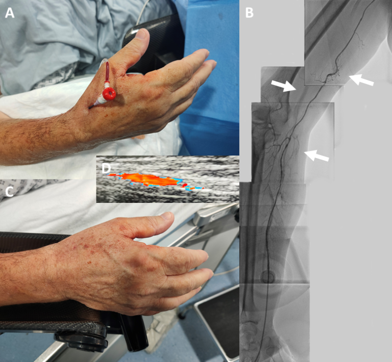 Heparin-free Distal Radial Artery Approach To Cardiac Catheterisation ...