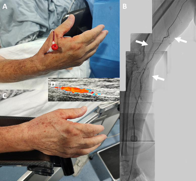 Lim - Figure 1. A. Distal radial artery cannulated with a 4Fr sheath. B. From the top of the picture the course of the radial recurrent artery has a loop (top arrow), and it joins the radial artery at the second loop (lower arrow). The middle arrow points to the parallel brachial artery. C. Haemostasis with manual pressure following removal of the sheath. D. Doppler ultrasound of the patent radial artery