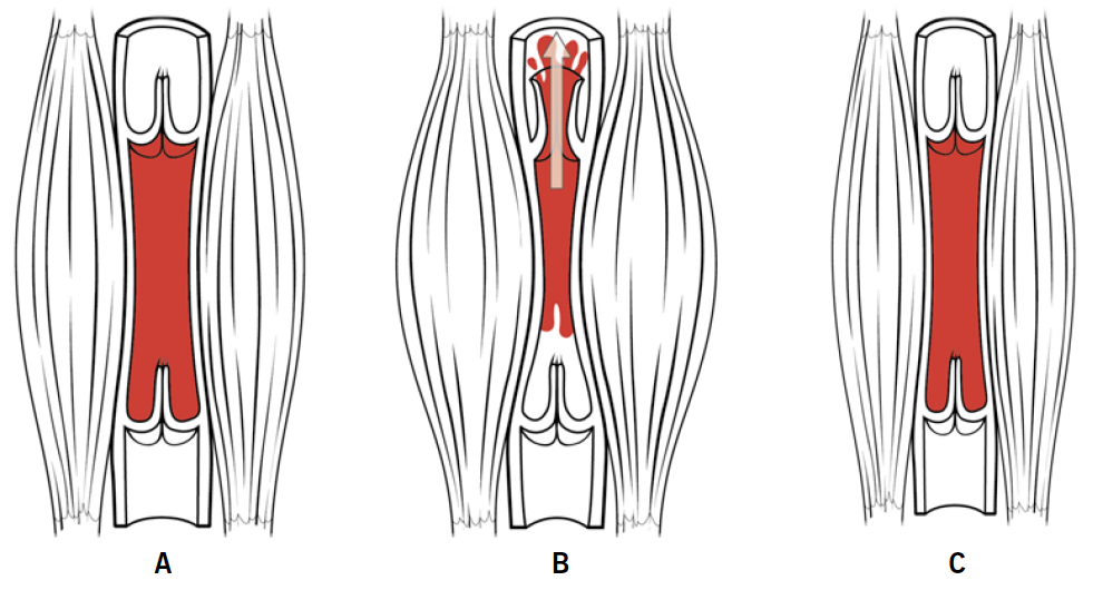 Sever - Figure 1. A. Muscles relaxed, valves closed. B. Muscles contracted, valve above muscle opens. C. Loss of skeletal muscle bulk, on contraction valves remain closed