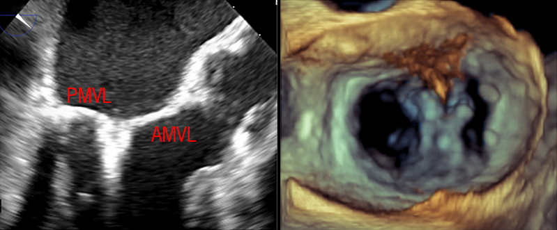 Ganatra - Figure 3. A. Transoesophageal echocardiography (TOE) demonstrating a MitraClip attaching the posterior (PMVL) and anterior mitral valve leaflets (AMVL). B. Three-dimensional image in ‘surgical view’ showing a double orifice mitral valve and two central MitraClips