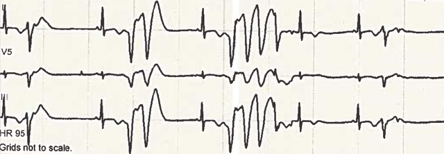 Daoub - Figure 2. ECG showing non-sustained polymorphic ventricular tachycardia