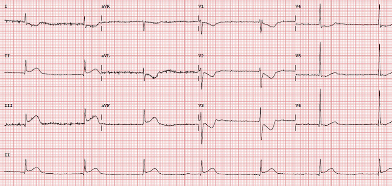 Ahmad - Figure 1. ST elevation in inferior leads (with reciprocal anterior changes)