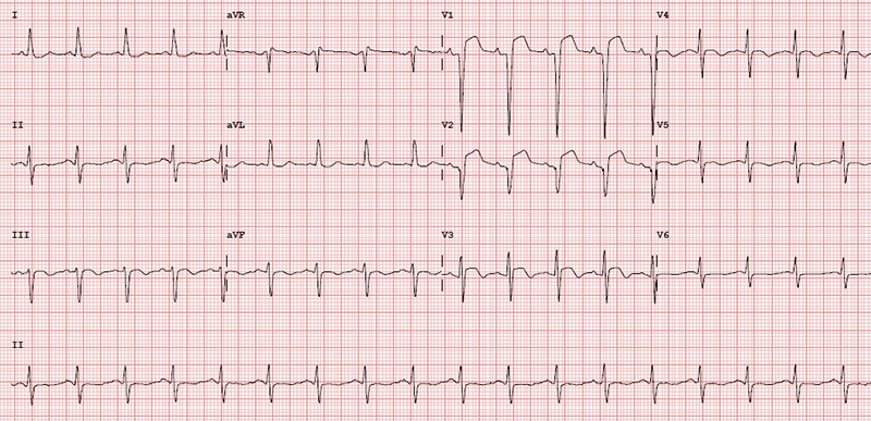 Ahmad - Figure 4. ST elevation in anterior leads