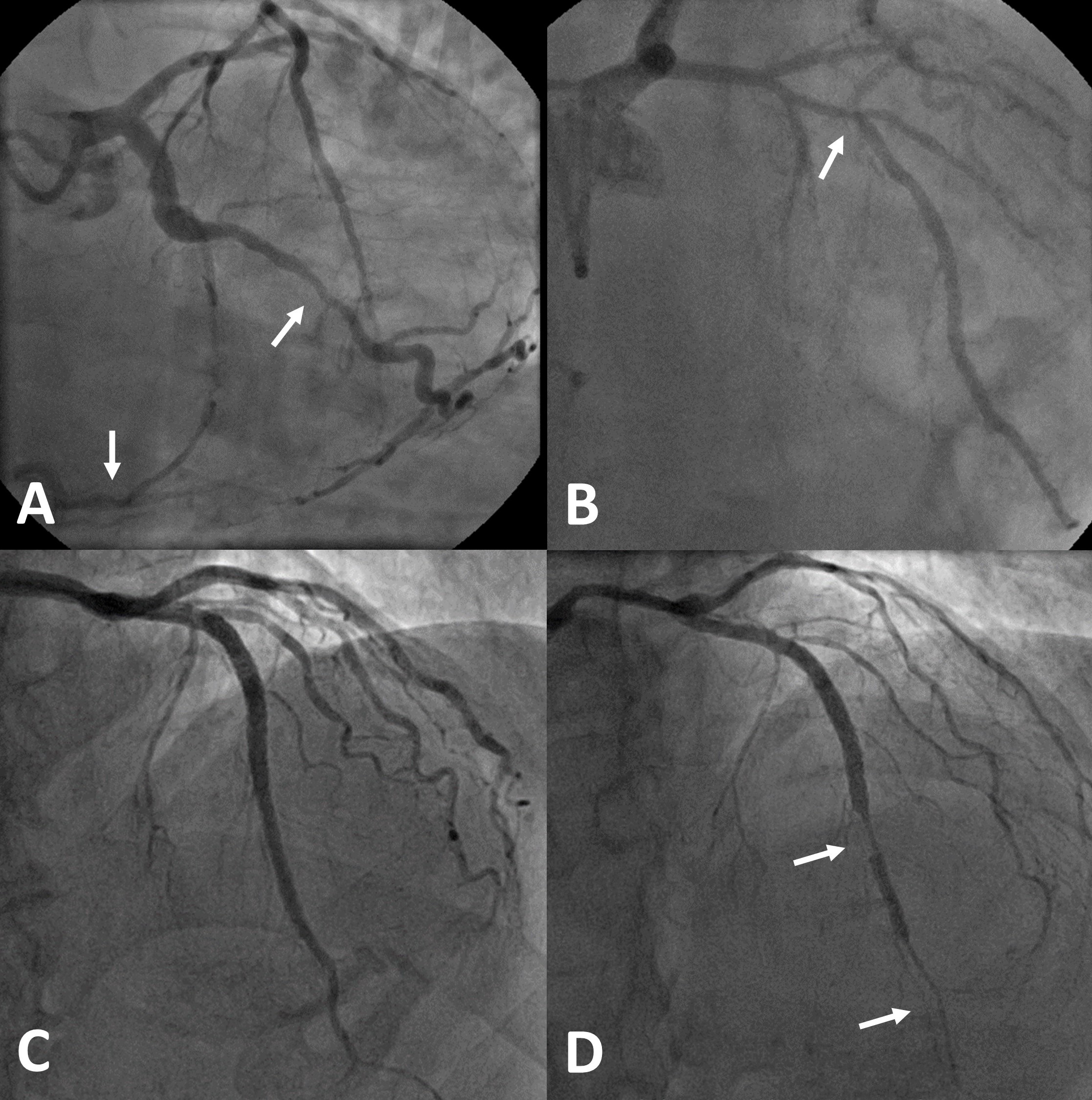 Lim - Figure 1. A. and B. A 37-year-old man’s coronary angiogram in 2017, pressure-wiring of the left anterior descending artery (LAD) then gave a fractional flow reserve (FFR) of 0.77 (>0.80), his stress echocardiogram at the time also showed 2/17 ischaemic segments in the LAD, but he managed 9 minutes on Bruce protocol treadmill test. The right coronary artery, which was previously stented, is occluded and beyond the mid-circumflex artery with a patent stent, there is significant disease in the large obtuse marginal branch. Cardiac surgery was advised in view of the progressive three-vessel coronary artery disease, but he opted for medical treatment and exercise training. Five years later and now aged 42, he completed 9 minutes of exercise testing without angina or echocardiographic cardiac ischaemia. This case illustrates the compensatory prowess of an intact microvasculature in a young person. C. and D. A 67-year-old man who had stenting of his LAD with two non-overlapping stents one month prior following non-ST-elevation myocardial infarction. He had an outpatient stress echocardiogram that revealed no cardiac ischaemia but continued to suffer regular angina, which he did not have before, culminating with multiple hospital admissions and a follow-up coronary angiogram that showed severe coronary artery vasospasm in the unstented LAD segments. This case illustrates stent-exacerbated epicardial coronary artery endothelial dysfunction (see text), and he responded to calcium-channel blockade