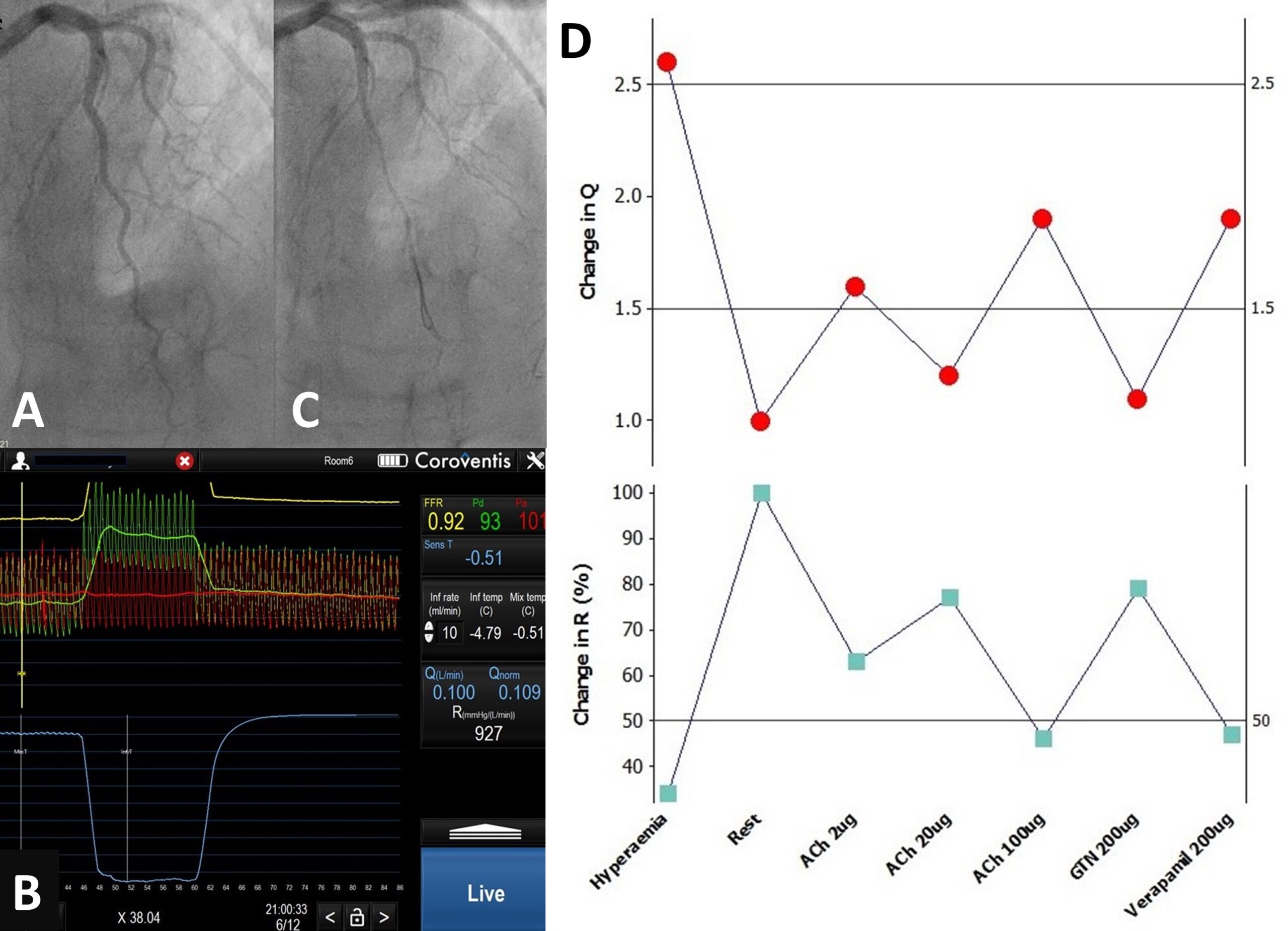 Lim - Figure 2. A. Unobstructed LAD. B. Normal microvascular endothelial function with low-dose acetylcholine. C. Epicardial coronary artery spasm with high-dose acetylcholine.  D. Coronary flow and resistance inversely mirroring each other in response to drugs