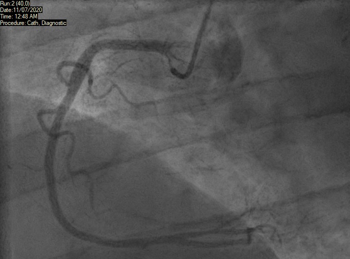 Ahmad - Figure 2. Normal right coronary artery