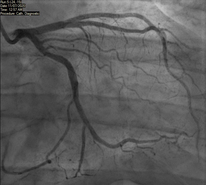 Ahmad - Figure 3. Left coronary system on coronary angiogram