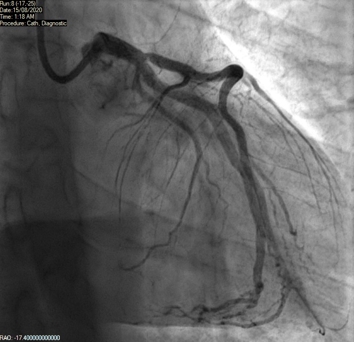 Ahmad - Figure 5. Ostial left anterior descending (LAD) thrombus