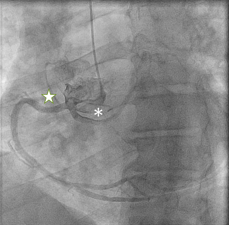 Coffey - Figure 1. Cardiac catheterisation with right coronary artery marked by green outlined star and left coronary artery marked by asterisk symbol