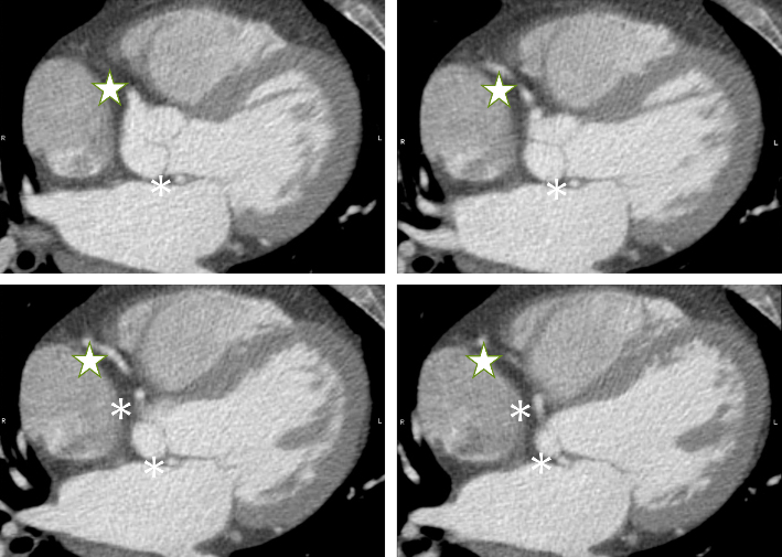 Coffey - Figure 2. Coronary computed tomography angiography (CCTA) with right coronary artery marked by green outlined star and left coronary artery marked by asterisk symbol