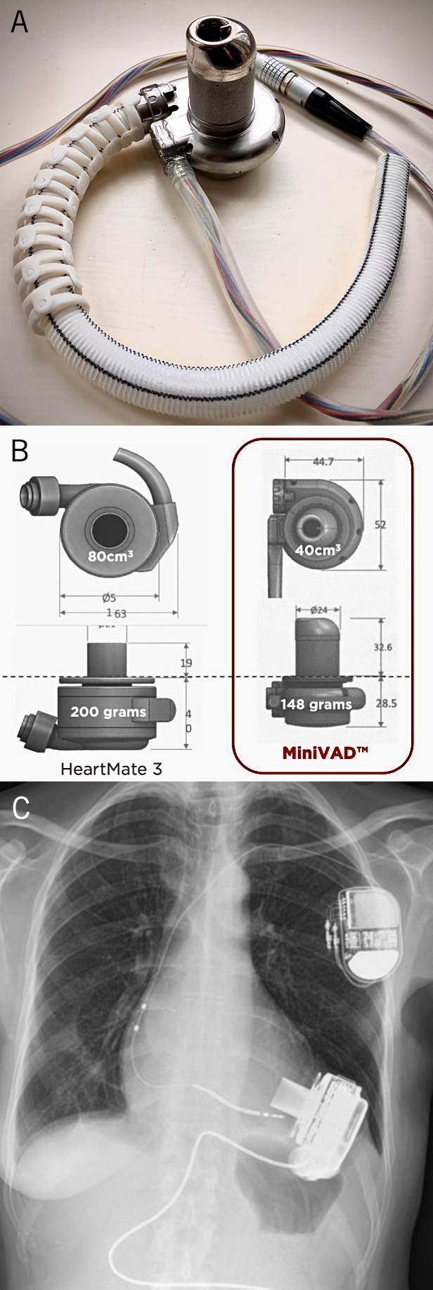 Westaby - Figure 3. A. The Calon CardioTechnology MiniVAD with its vascular graft. B. Comparative sizes (in millimetres) of the Calon MiniVAD and HeartMate 3 device. C. X-Ray showing the HeartMate 3 device implanted