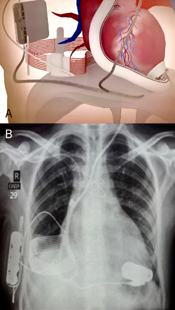 Westaby - Figure 5. CETS implanted into a patient for the first time with the Jarvik 2000 Heart. A skull pedestal-based percutaneous power line was used as a backup. A. Diagram of the system. B. Plain chest X-ray of the patient showing the implanted components. All data regarding power consumption and pump speed are relayed to the external wrist watch