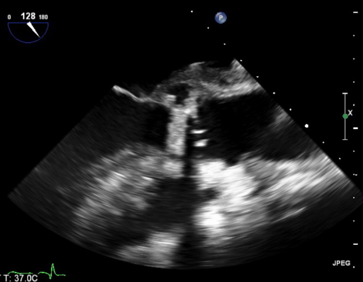 Boyle - Figure 1. Transoesophageal echocardiography (TOE) showing vegetation measuring over 3.3 cm<sup>2</sup> in the aortic valve with large aortic root abscess