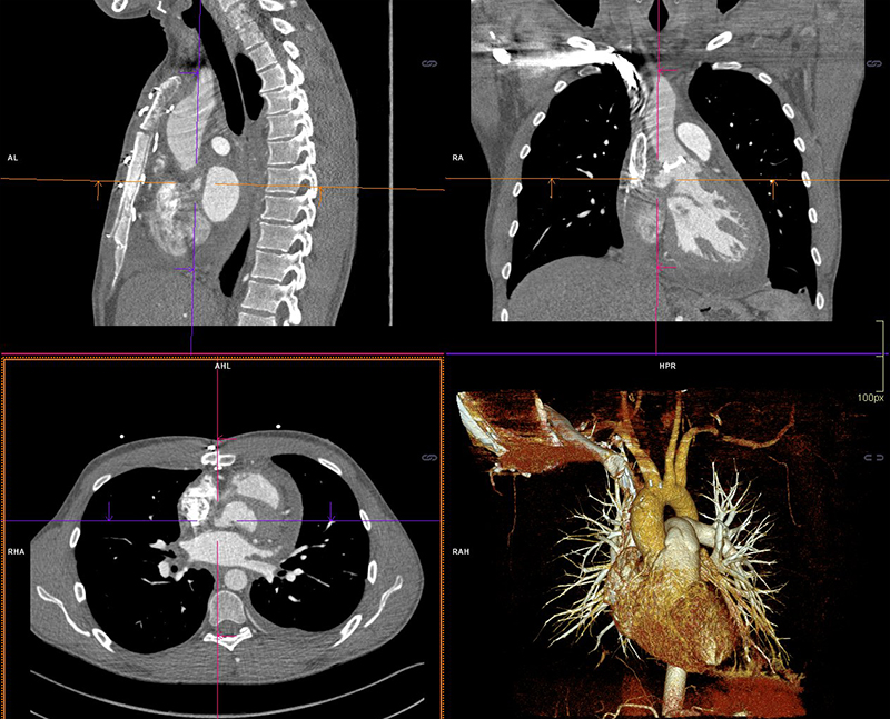 Boyle - Figure 2. Computed tomography (CT) imaging and 3D reconstruction of focal outpouchings in keeping with aortic root abscesses