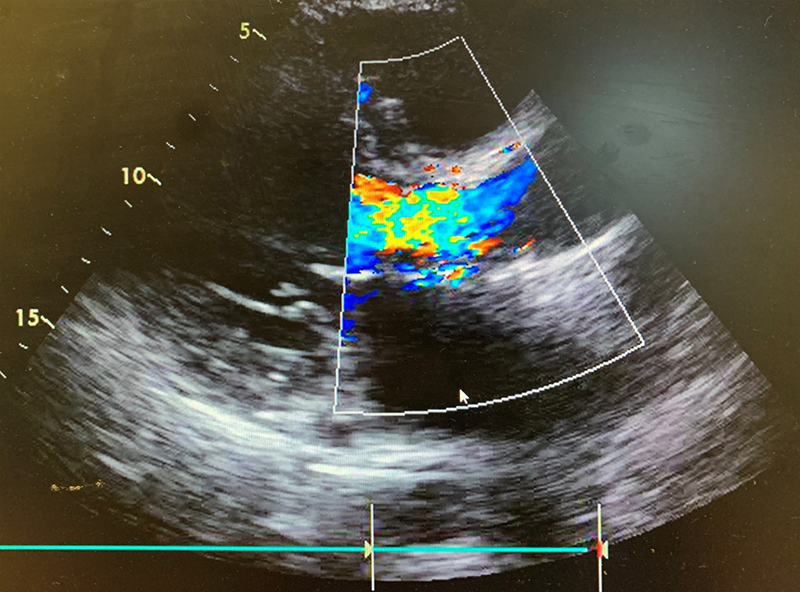 Boyle - Figure 3. Transthoracic echocardiography (TTE) showing severe aortic regurgitation