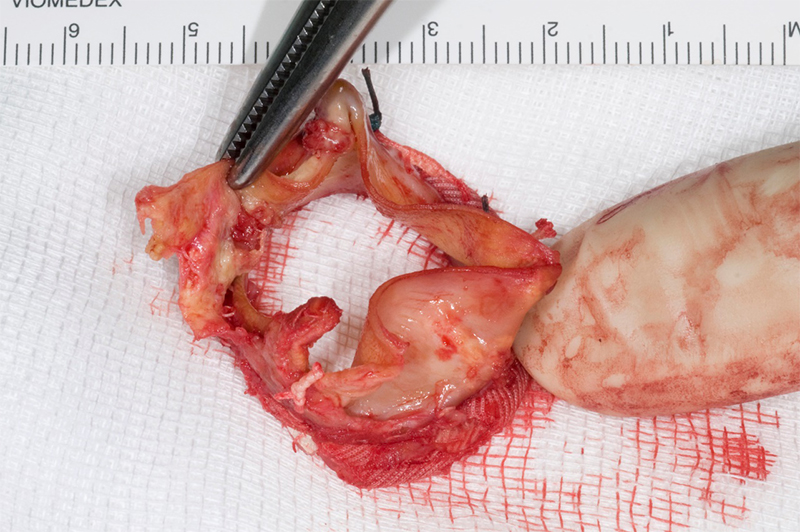 Boyle - Figure 4. Excised bioprosthetic aortic valve replacement