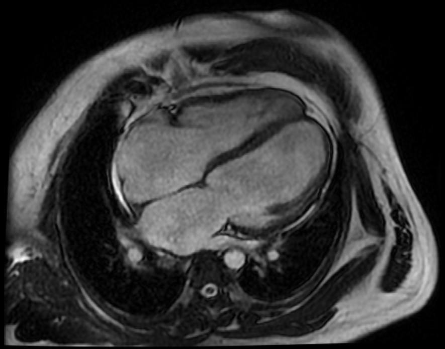 Cáceres-Acosta - Figure 1. Cardiac resonance image in four-chamber view in which marked dilation is observed in both atria and ventricles