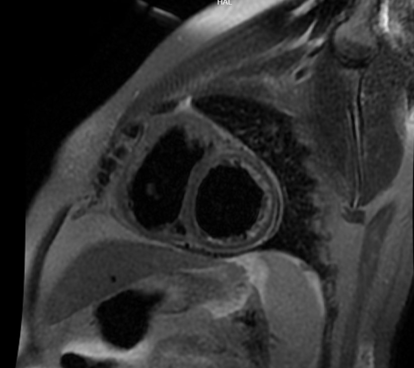 Cáceres-Acosta - Figure 2. Cardiac magnetic resonance image in short-axis view at the level of the ventricles in ‘black blood’ sequence in which significant oedema of the lateral and inferolateral meso and epicardial walls is observed