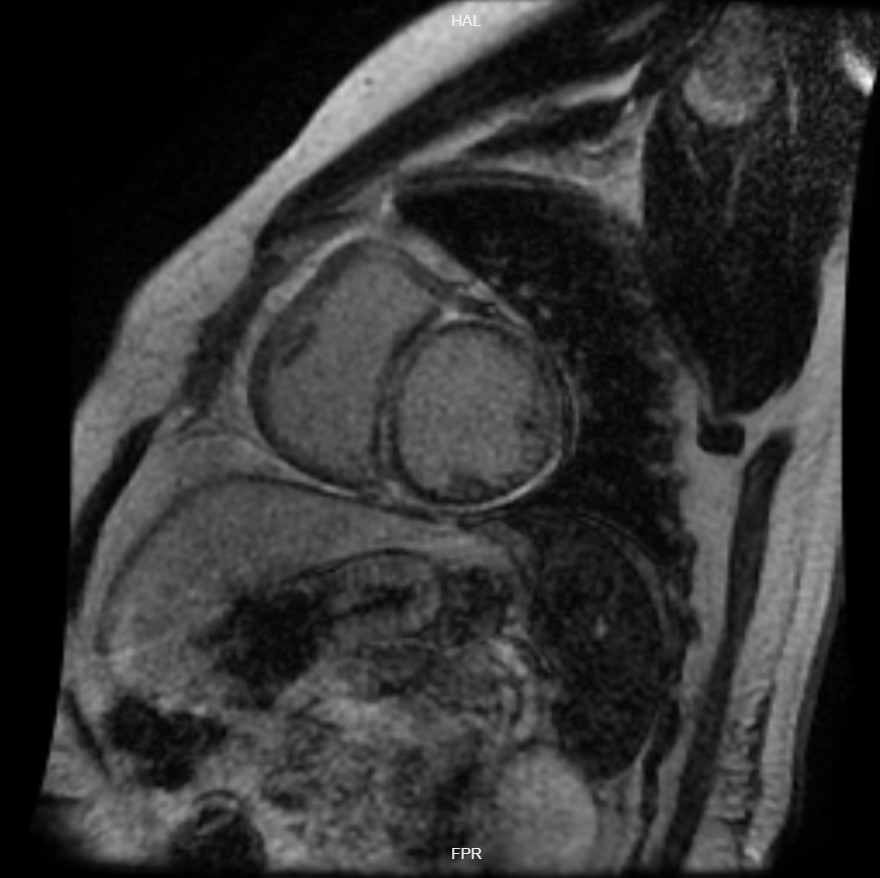 Cáceres-Acosta - Figure 3. Cardiac magnetic resonance image in short-axis view, with late-phase gadolinium, showing enhancement that compromises the meso and epicardium of the interventricular septum, lateral, inferolateral, and inferior walls