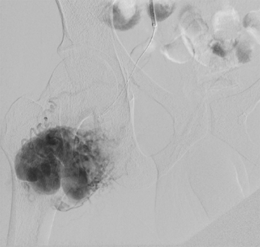 Liberman - Figure 2. Diagnostic arteriography showing right pelvic AVM